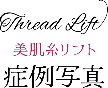 Thread Lift 美肌糸リフト 症例写真